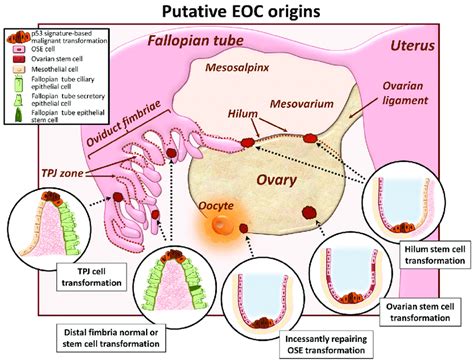 Ovarian Cancer Diagram