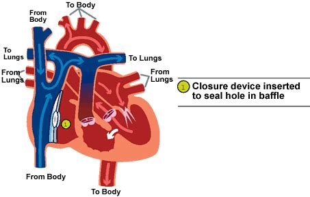 Tricuspid Atresia | CS Mott Children's Hospital | Michigan Medicine