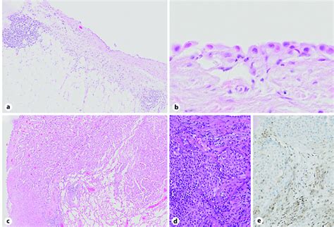 a Low-power view of the initial pleural biopsy being consistent with ...