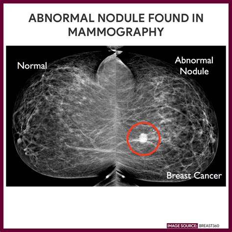 Mammography (Mammogram) - Nursing Responsibilities - Nurseslabs