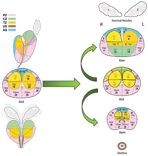 Influence of the Location and Zone of Tumor in Prostate Cancer ...