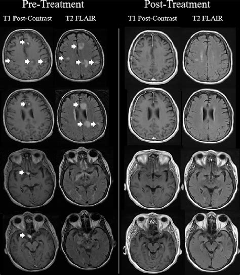 Case 2: An initial axial T1 postcontrast and T2 FLAIR MRI brain scan ...