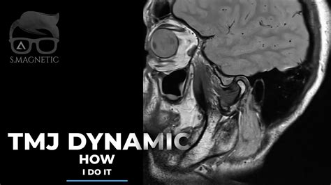 ️ MRI TMJ Dynamic View - YouTube