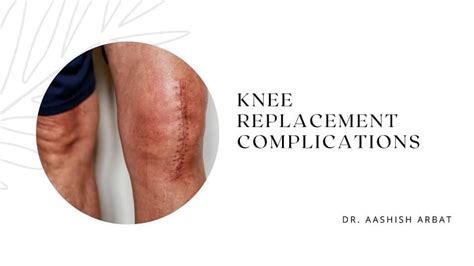 Knee Replacement Complications - Splash