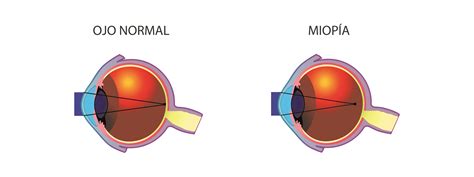 Miopía defecto refractivo | Cirugía refractiva | Oftalmedic Salvà Palma