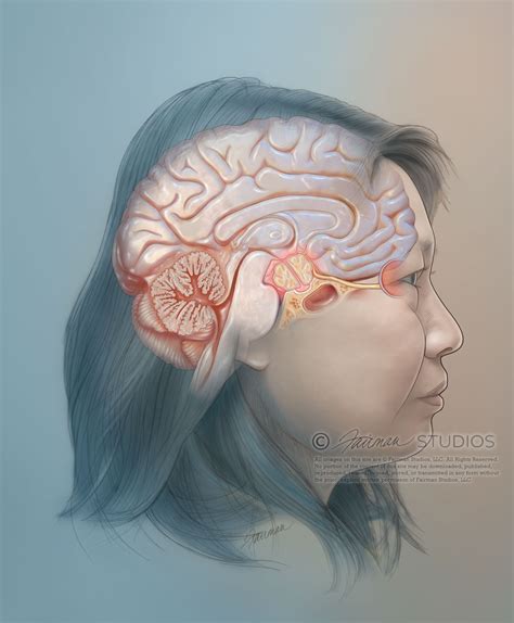 Craniopharyngioma - Fairman Studios