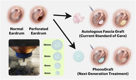 PhonoGraft: 3D Printed Tympanic Membrane Graft