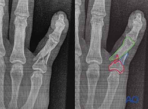 Wedge/multifragmentary fracture of the diaphysis