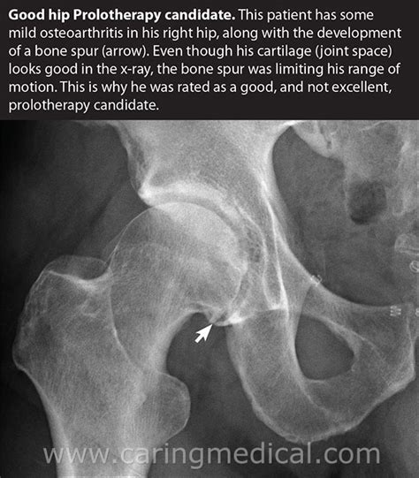 Osteoarthritis X Ray Hip