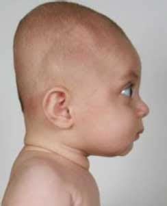 MEDICAL IMAGES: Brachycephaly