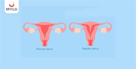 Septate Uterus: Symptoms, Risks and Treatment Options | MyloFamily