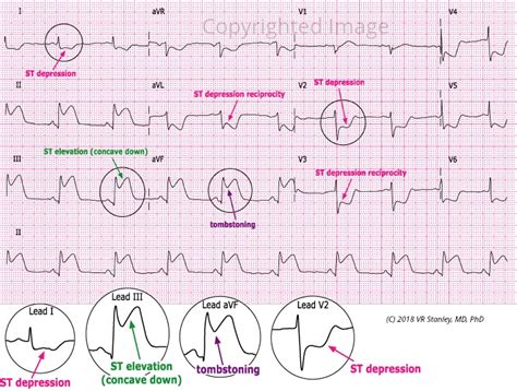 Acute Inferior STEMI - Dr. Stanley's ECGcourse.com Dr. Stanley's ...