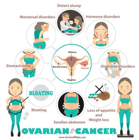 Ovarian Cancer Anatomy