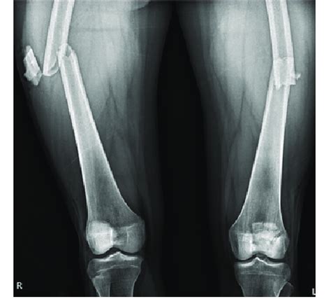 Plain radiograph showing bilateral femur shaft fracture with comminuted ...