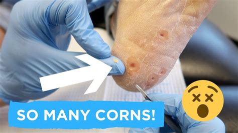 SUPER SATISFYING CORN REMOVAL! - YouTube