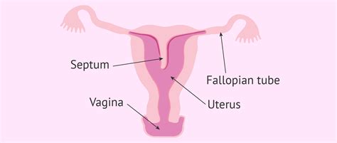 Diagram of a septate uterus