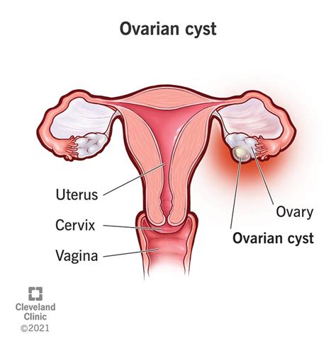 Ovarian Cysts: Causes, Symptoms, Diagnosis & Treatment