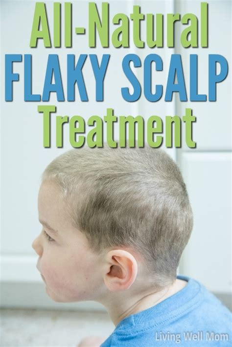 Flaky Scalp Treatment {Natural Dandruff Remedies} - Living Well Mom