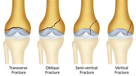 Femur Fracture