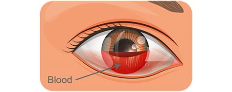 Hyphema (Bleeding in the eye) | Sidra Medicine