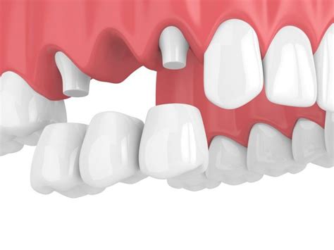 All About Removable Dental Bridges - Dentist in New Orleans, LA