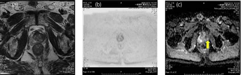 Multiparametric MRI images of the prostate. (a) T2 weighted image. (b ...