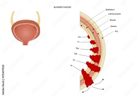 bladder cancer in its various stages, according to the TNM staging ...