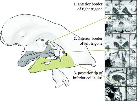 Temporal Horn Index and Volume of Medial Temporal Lobe Atrophy Using a ...