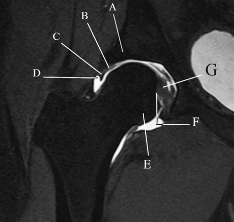 Coronal magnetic resonance arthrogram of the hip | The BMJ