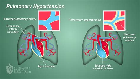 Pulmonary Hypertension Diagram