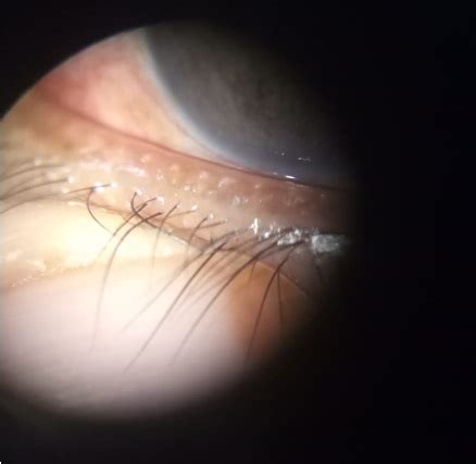 Meibomian gland probing in patients with meibomian gland dysfunction-IJCEO