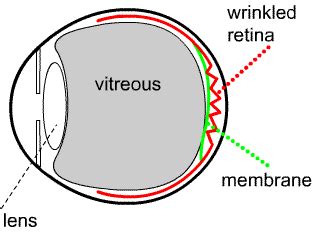 Epirental Membrane Surgery | Rockhampton Eye Clinic