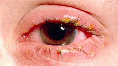 Eye Infections in Baby, Children & Adults - Causes, Diagnosis & Treatment