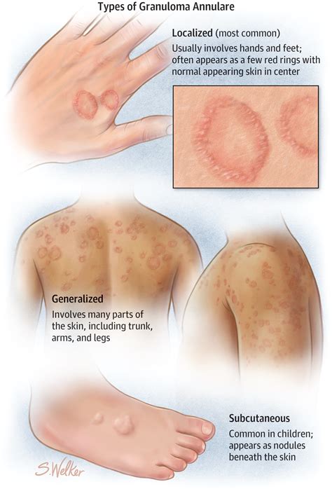 Granuloma Annulare | Granuloma annulare, Dermatology nurse, Medical ...