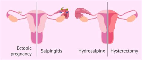 Salpingectomy: how and why are the Fallopian tubes extracted?