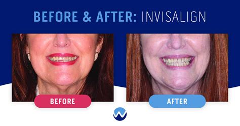 Clear Aligners Before & After: See How They Transform Smiles • Woodhill ...