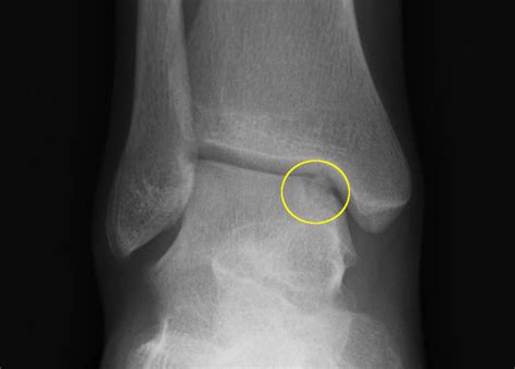 OCD Lesions of Talus - Yakima Foot & Ankle