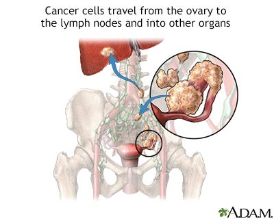 Malignancy Information | Mount Sinai - New York