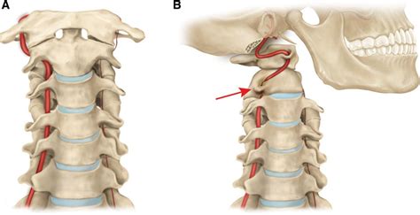 Rotational Vertebral Artery Occlusion | Stroke