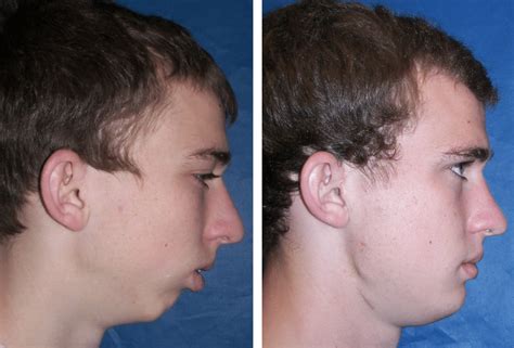 Before & After Case 20b TMJ surgery ankylosis - Larry M. Wolford, DMD