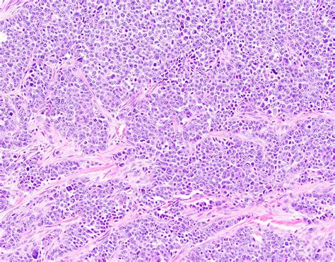 Pathology Outlines - Poorly differentiated neuroendocrine carcinoma