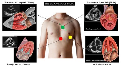 Focus on FoCUS: The 4 basic views of the heart – NephroPOCUS