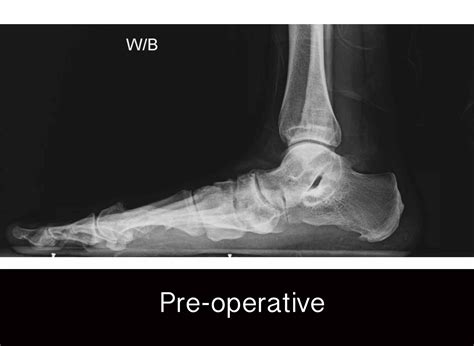 Surgery for flat foot deformities. – Dr. Nicholas Campitelli