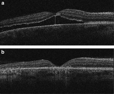 OCT scans for the same patient with chronic retinal detachment ...