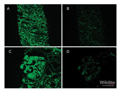 Light chain deposition disease | Wikilite