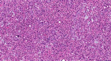 goblet cell adenocarcinoma Archives | Atlas of Pathology