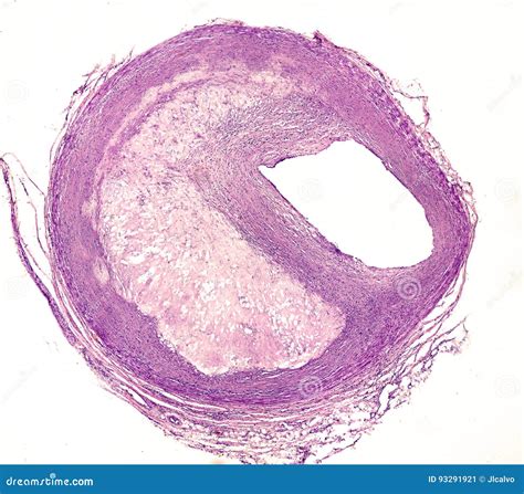 Atheroma plaque stock image. Image of vessel, artery - 93291921