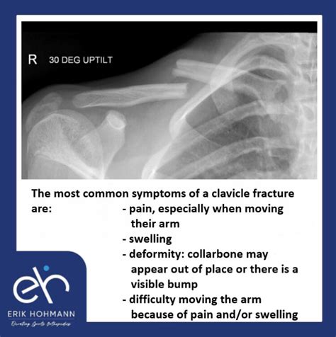 The most common symptoms of a clavicle fracture are - Dr. Erik Hohmann