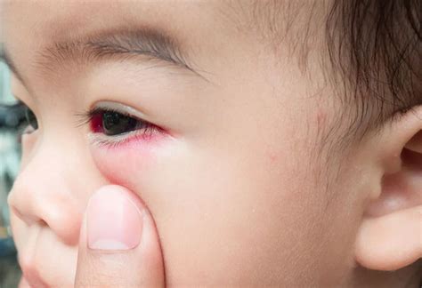 Baby Eye Infections - Types, Signs, Causes & Home Remedies