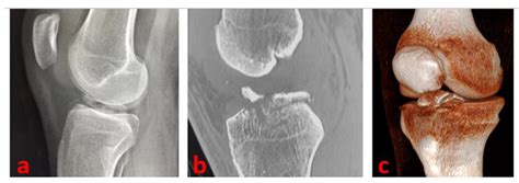 Healthcare | Free Full-Text | Technical Note: Tibial Spine Avulsion ...